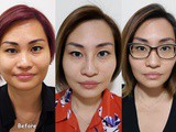 Goodbye Crows Feet & v-face maintenance with sl Clinic