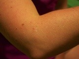 Did You Know…Mole Health