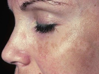 How i Reduced My Melasma with Apple Cider Vinegar