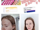 My experience with acne on the contraceptive pill (both the mini and combined pills)