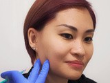 Botox experience with sl Clinic