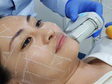 Ultherapy®: Non-invasive facelift at sl Clinic